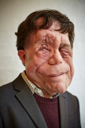 Adam Pearson in The Ugly Face of Disability Hate Crime